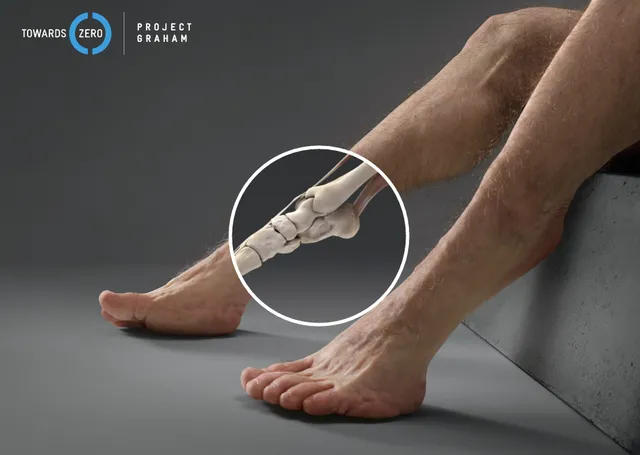 骨折　脛　人間工学