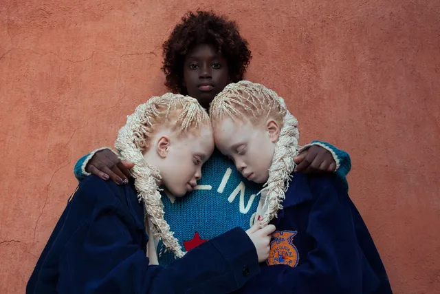 アルビノの双子とアフリカ系の女性